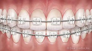 Ceramic Braces in San Diego i-Orthodontics - FREE Consultation
