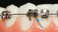 Ortho Emergency, Dulaney Orthodontics