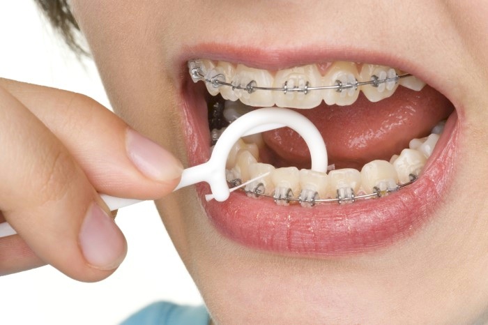 How to Floss With Braces? 