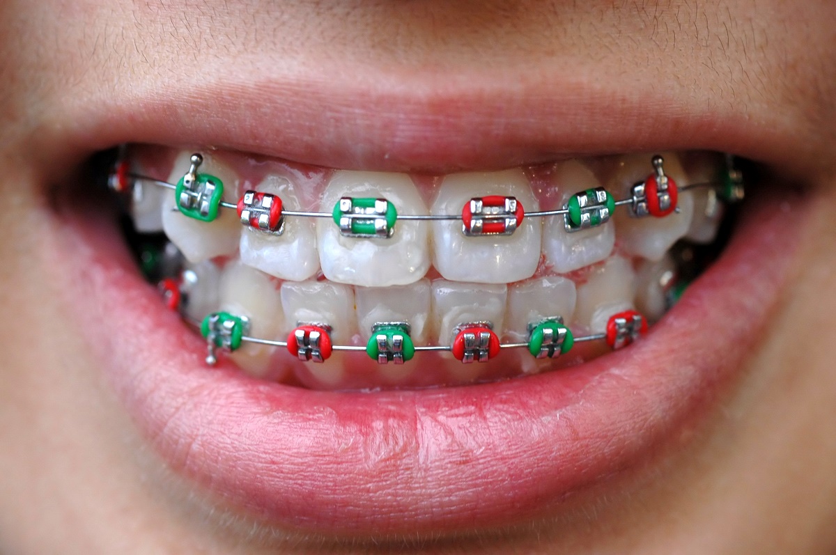 Colored Braces and Clear Braces: How to Decide - i-Orthodontics San Diego