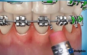 Emergencies  Metal Braces in Wayne County, Indiana