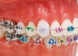 Caring For Braces I Orthodontics San Deigo Ca