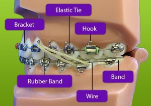 Caring for Braces - i-Orthodontics - San Deigo CA