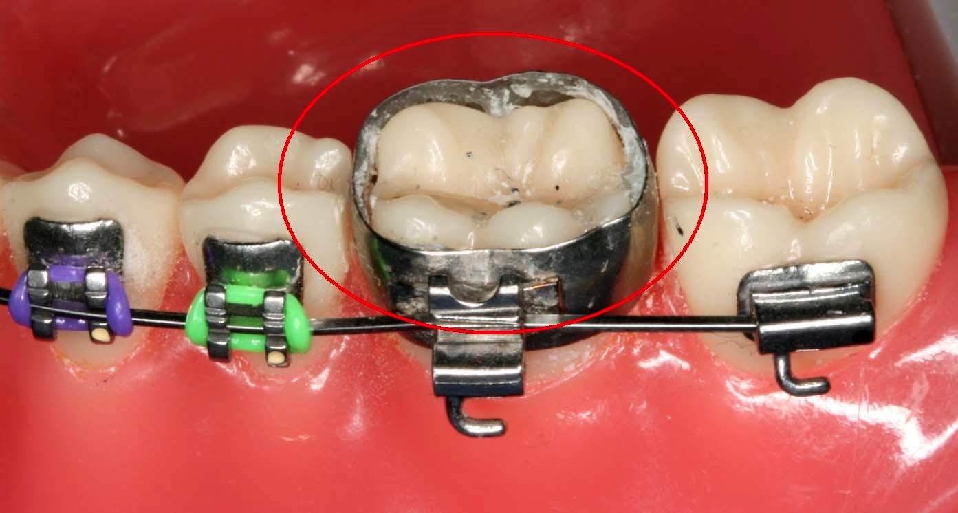 Caring for Braces iOrthodontics San Deigo CA