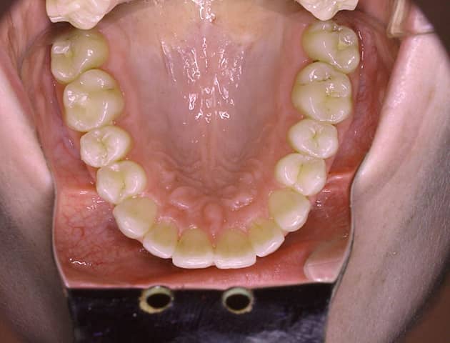 #2 Lower Teeth